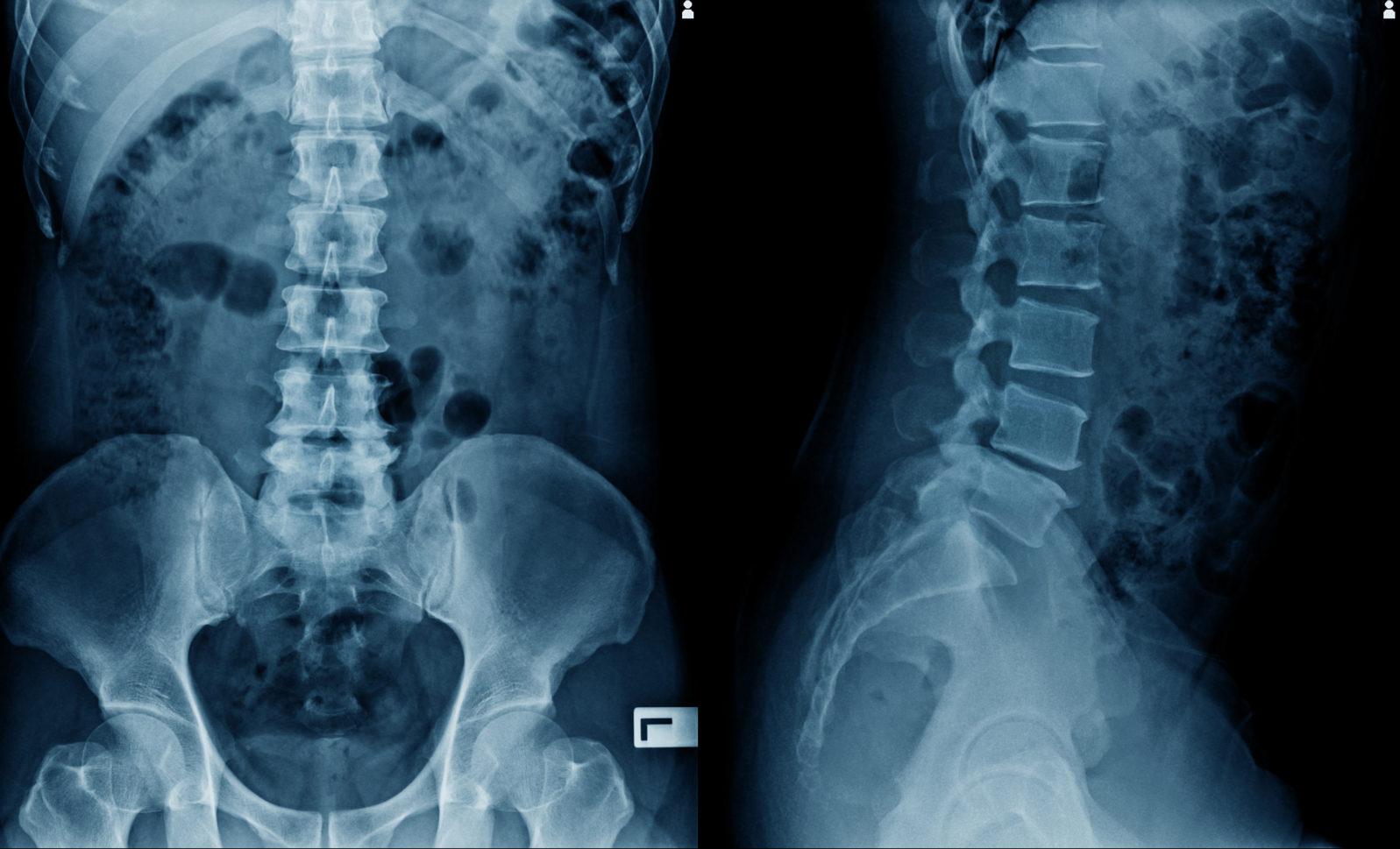 x-ray image of spine