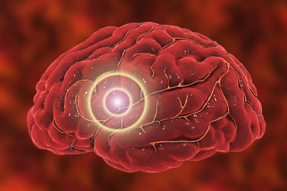 Brain stroke concept. Migraine and headache conceptual image, 3D illustration