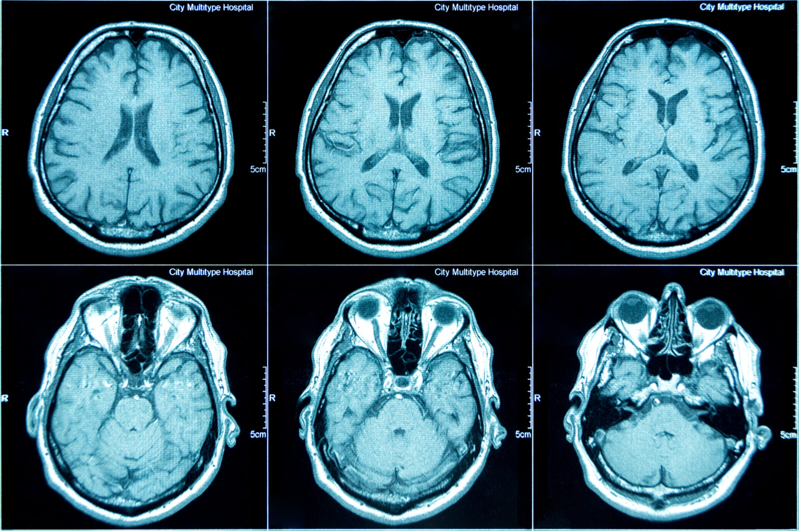 MRI scan of the brain